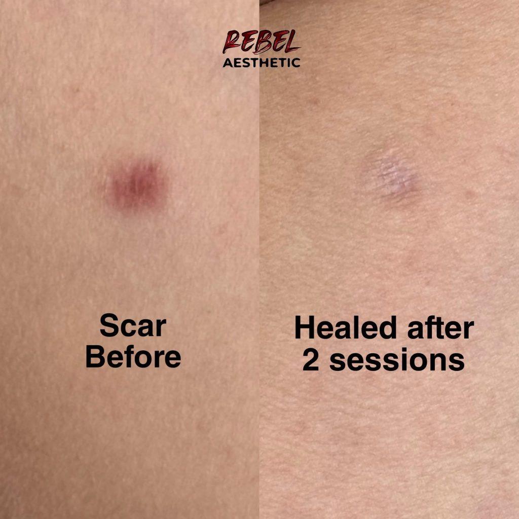 Scar before and healed after two camouflage sessions at Rebel Aesthetic