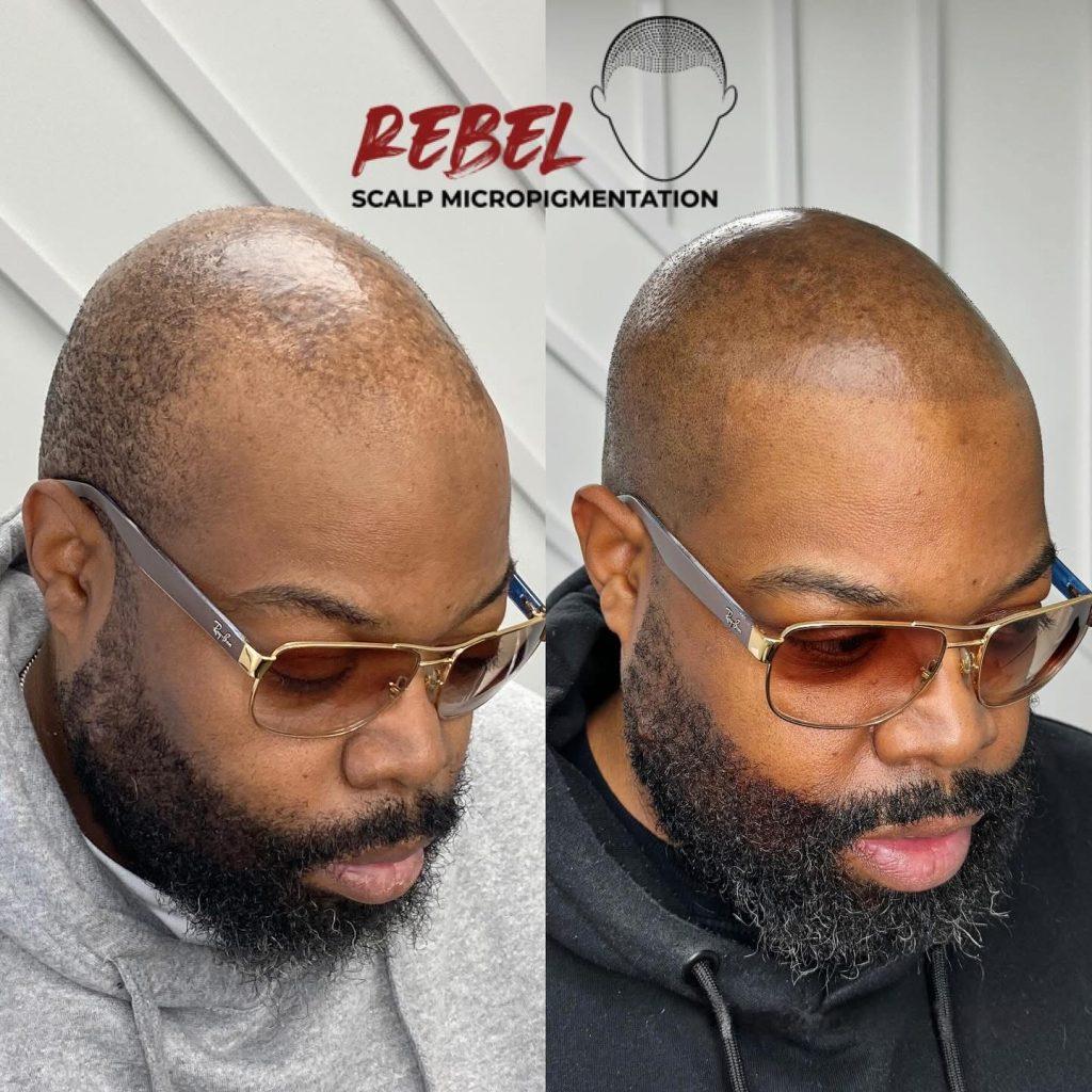 Scalp micropigmentation before and after at Rebel Aesthetic