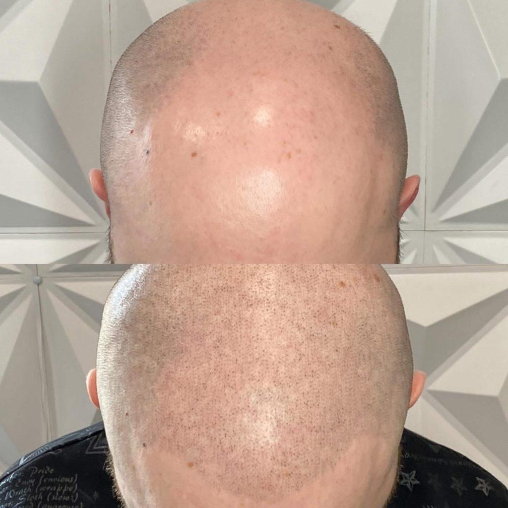 Scalp micropigmentation result at Rebel Aesthetic