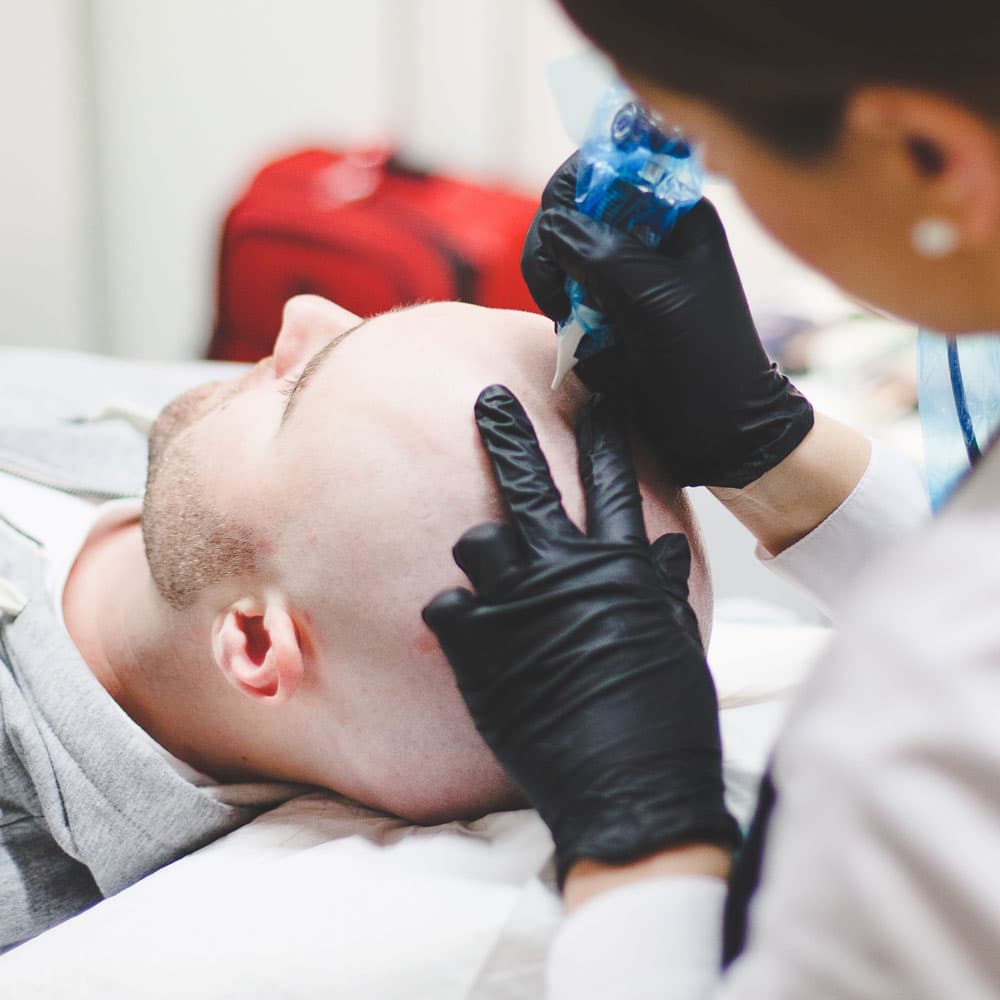 Scalp Micropigmentation example 2