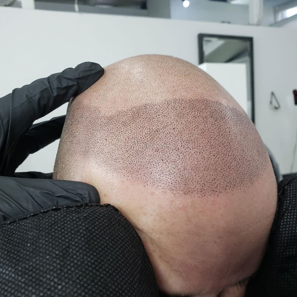 Scalp Micropigmentation example 4