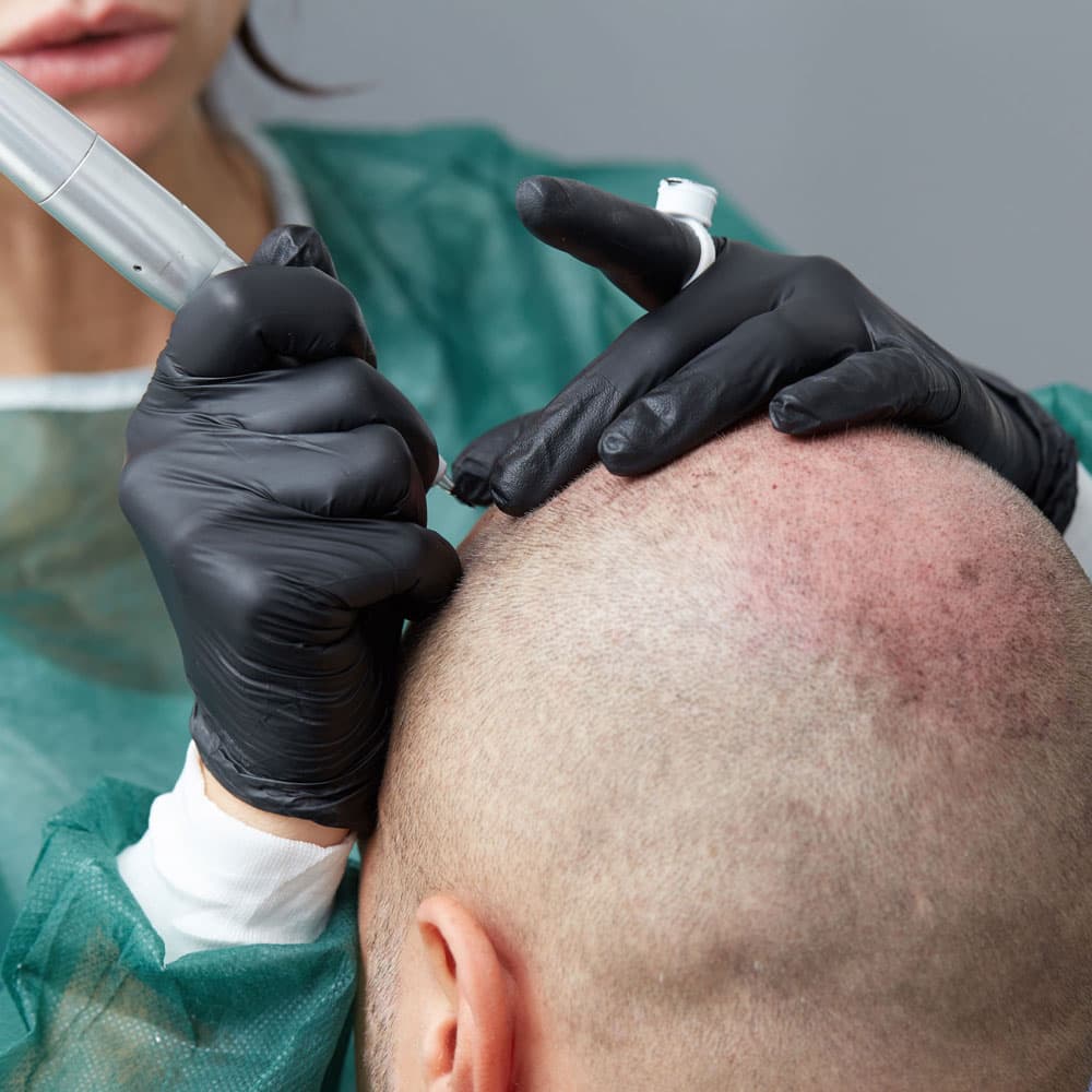 Scalp Micropigmentation example 3