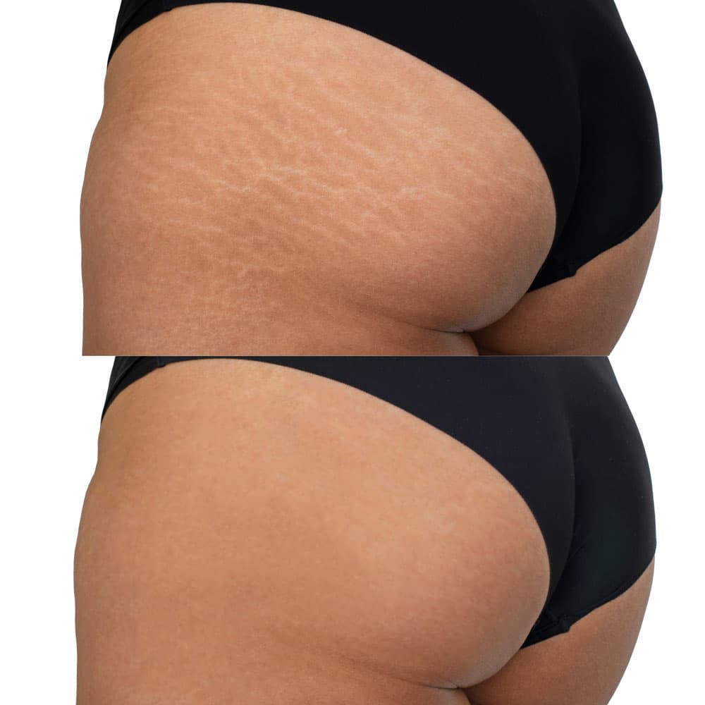 Stretch mark revision